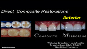 Direct Composite Restorations: Anterior, Posterior, Finishing & Polishing