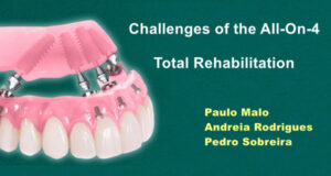 Сhallenges of the All-On-4 Total Rehabilitation