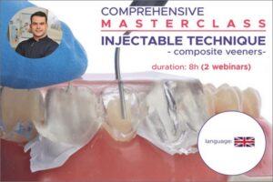 Composite Veneers