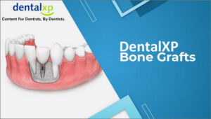 Vertical & Horizontal Bone Grafts