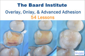 Overlay, Onlay, & Advanced Adhesion