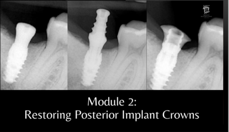 Implant Restorations Simplified: Restore Dental Implants with Accuracy ...