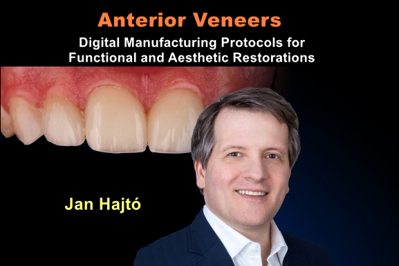Anterior Veneers