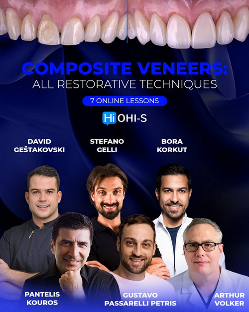 Composite Veneers