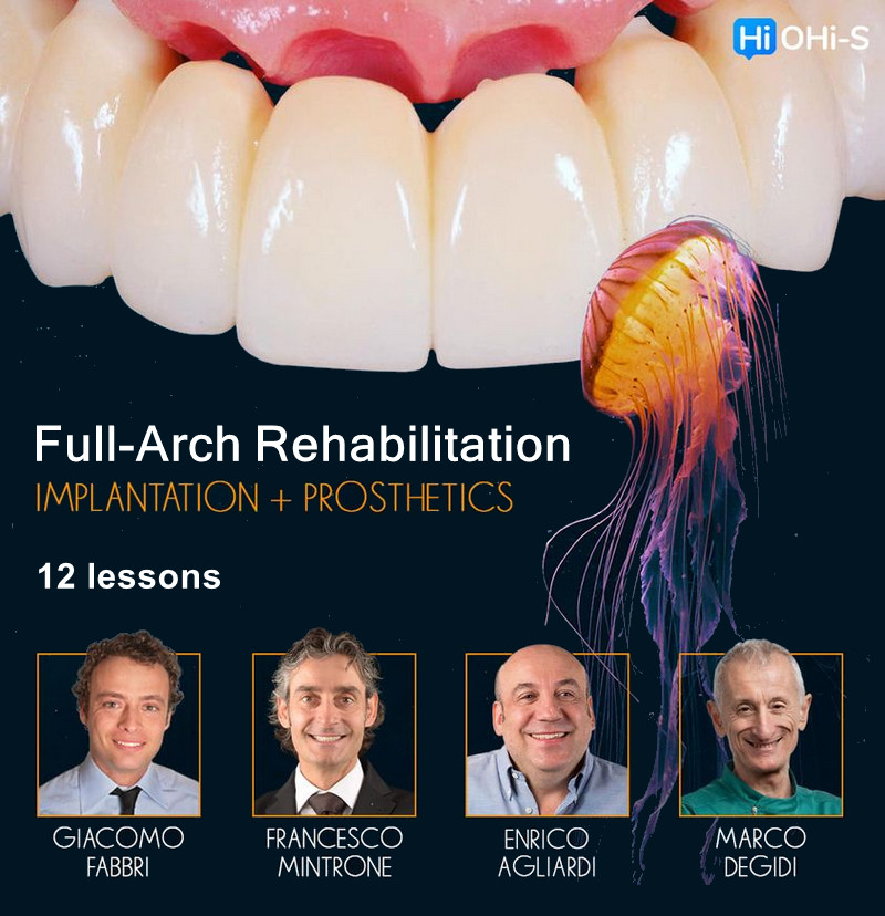Full-Arch Rehabilitation