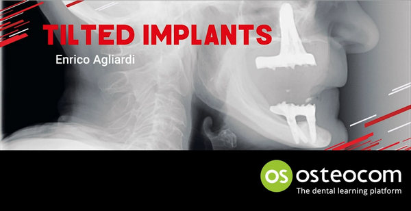 Tilted Implants
