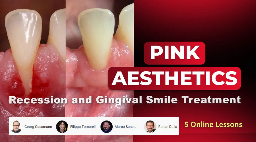 Pink Aesthetics: Recession and Gingival Smile Treatment